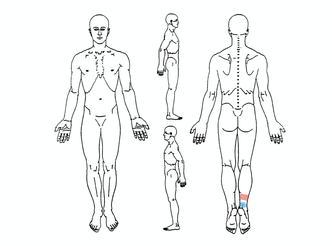 Achilles tendinopathy