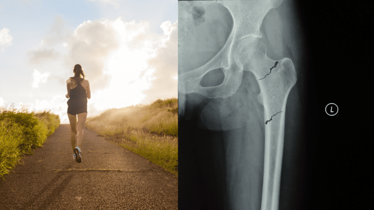 Dont miss femoral stress fractures in the female runner