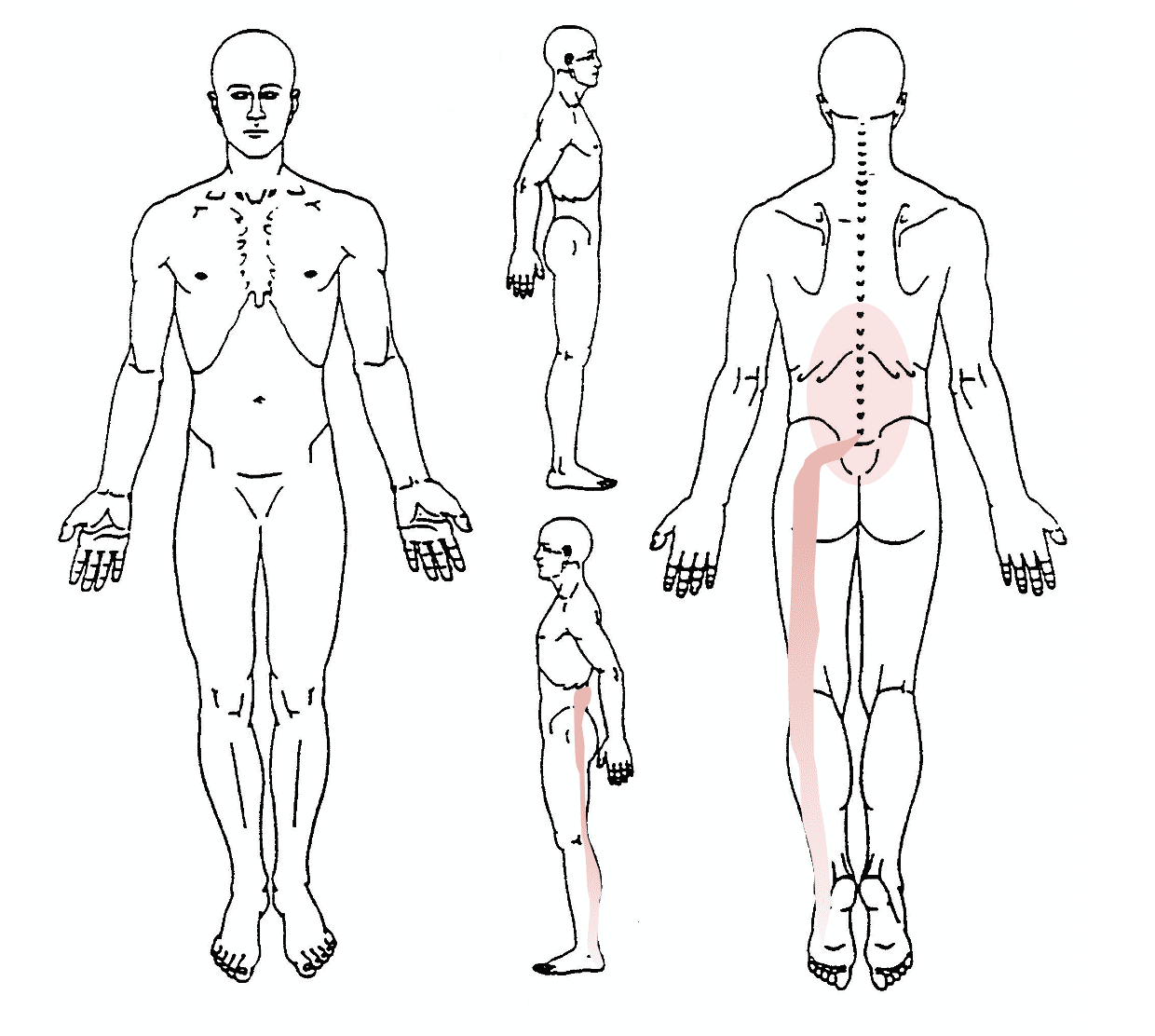 Lumbar radicular syndrome pain diagram