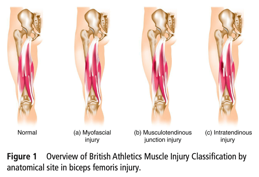 Hamstring Injury Classification and Rehabilitation - Physiotutors