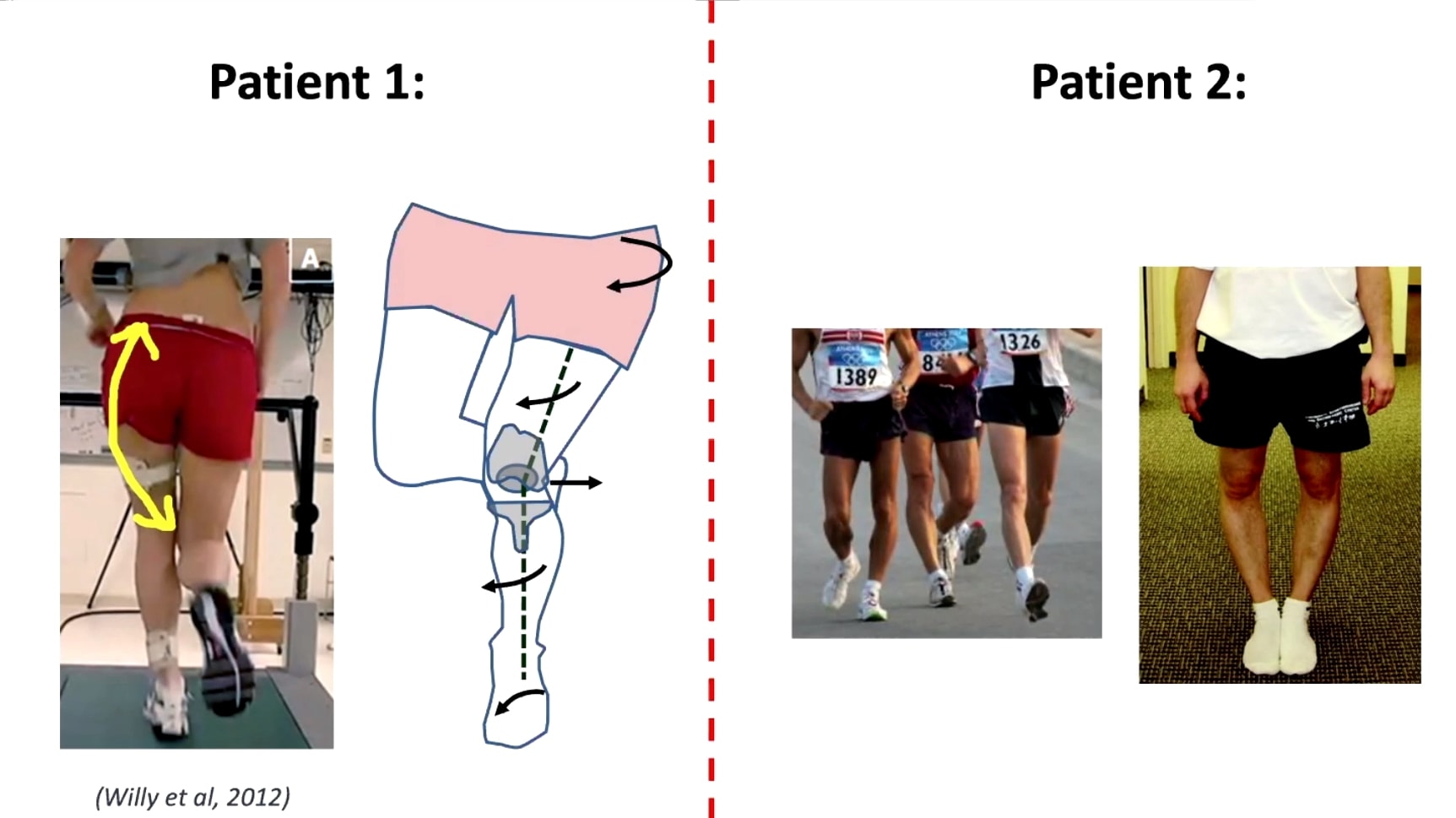 ITB Syndrome The iliotibial band - Roche Injury Clinic