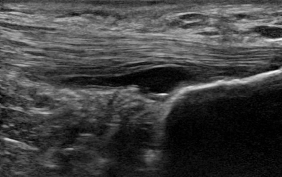 Achilles tendon partial rupture