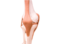 Patellofemoral pain