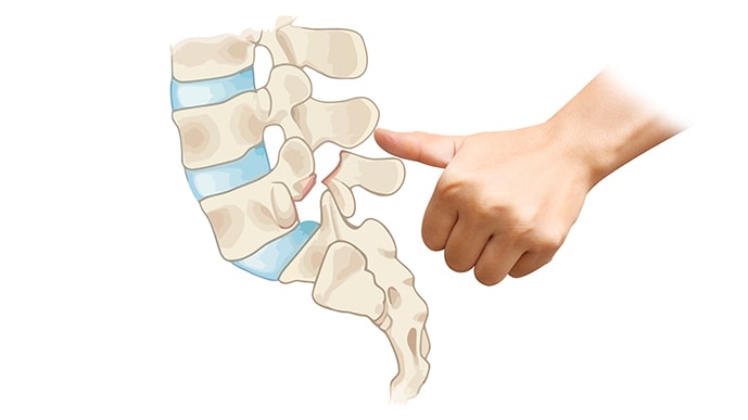 Low Midline Sill Sign Radiographic Lumbar Instability Assessment
