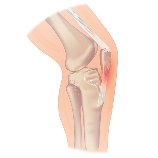 Symptômes et diagnostic de la tendinite du talon rotulien