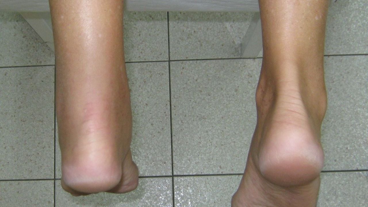 Achilles tendinopathy water retention