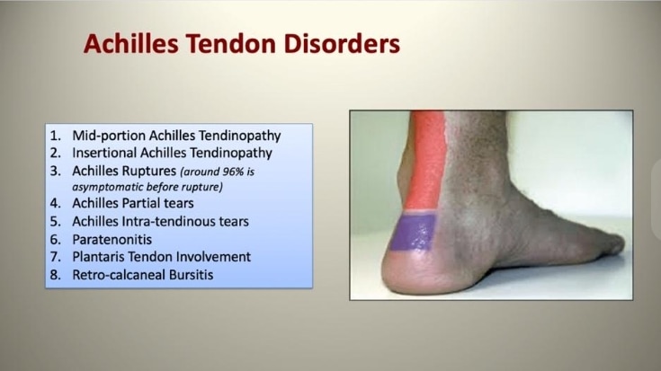 Achilles tendinopathy clinical presentation