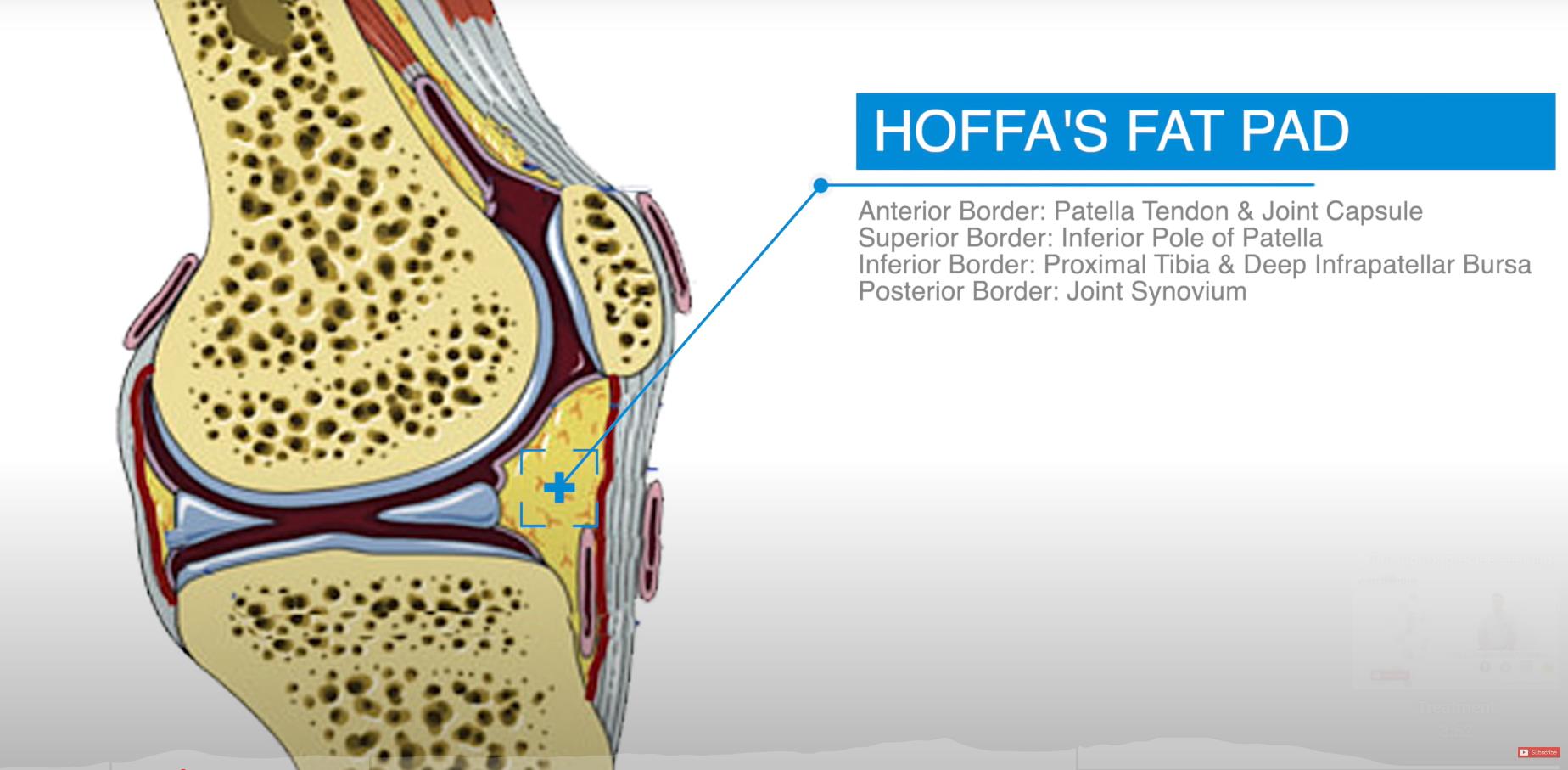 Infrapatellar Fat Pad Syndrome Diagnosis Treatment