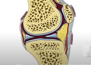 Infrapatellar fat pad syndrome