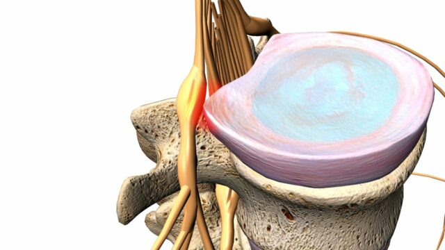 Lumbar radicular syndrome