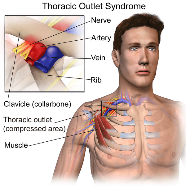 diep Honger paling Thoracic Outlet Syndrome | Diagnose & Behandeling voor Fysio's