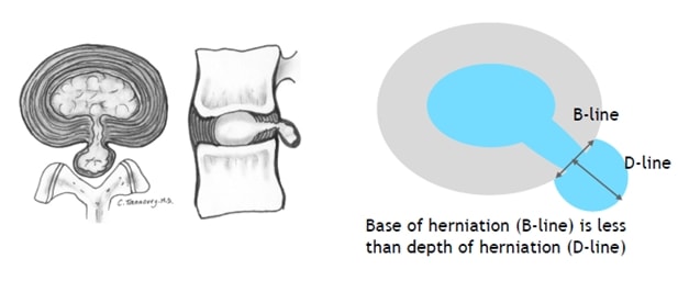 Lumbar disc extrusion. colección de la La Unidad Especializada en