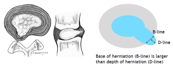 Disk protrusion