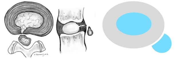 6 datos sobre la hernia discal lumbar que todo el mundo debe conocer