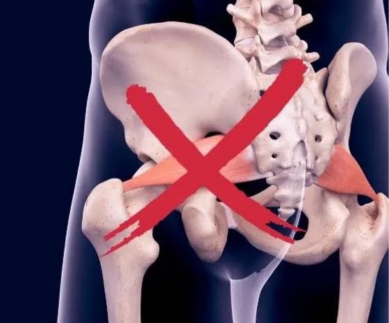 Piriformis Syndrome: It's Not About The Tennis Ball