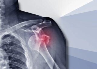 Unstable shoulder featured