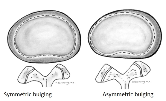 Disk bulging