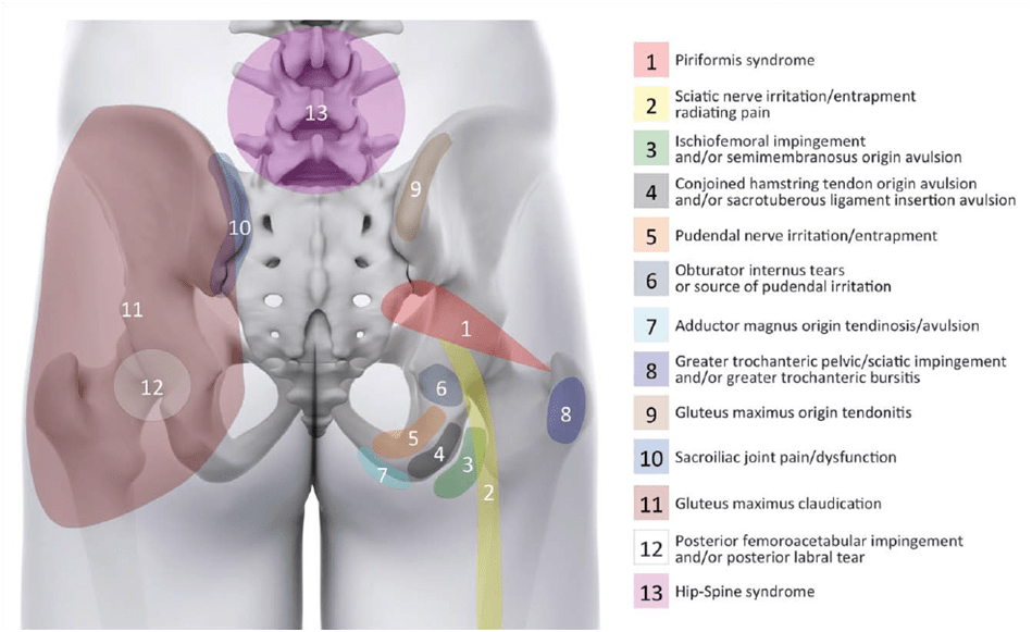 Sciatica: What a Pain in the Buttocks! - Physiovive