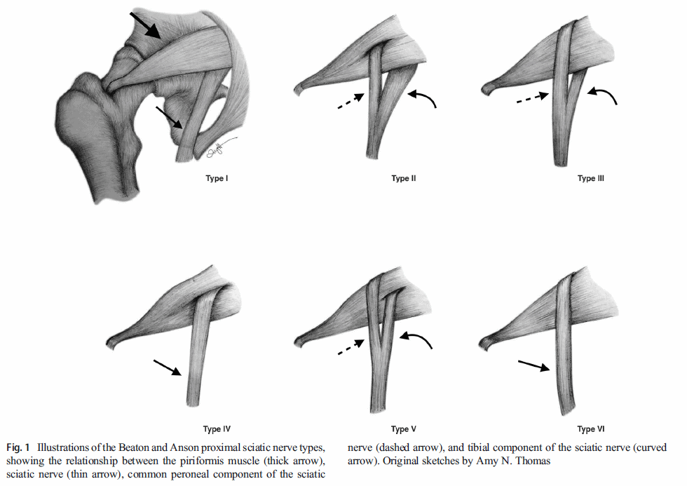 Pain in the butt? It could be Piriformis Syndrome! - Triangle