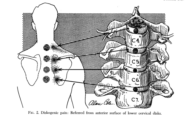 The Little-Known Cause of Pain Between the Shoulder Blades - PainHero