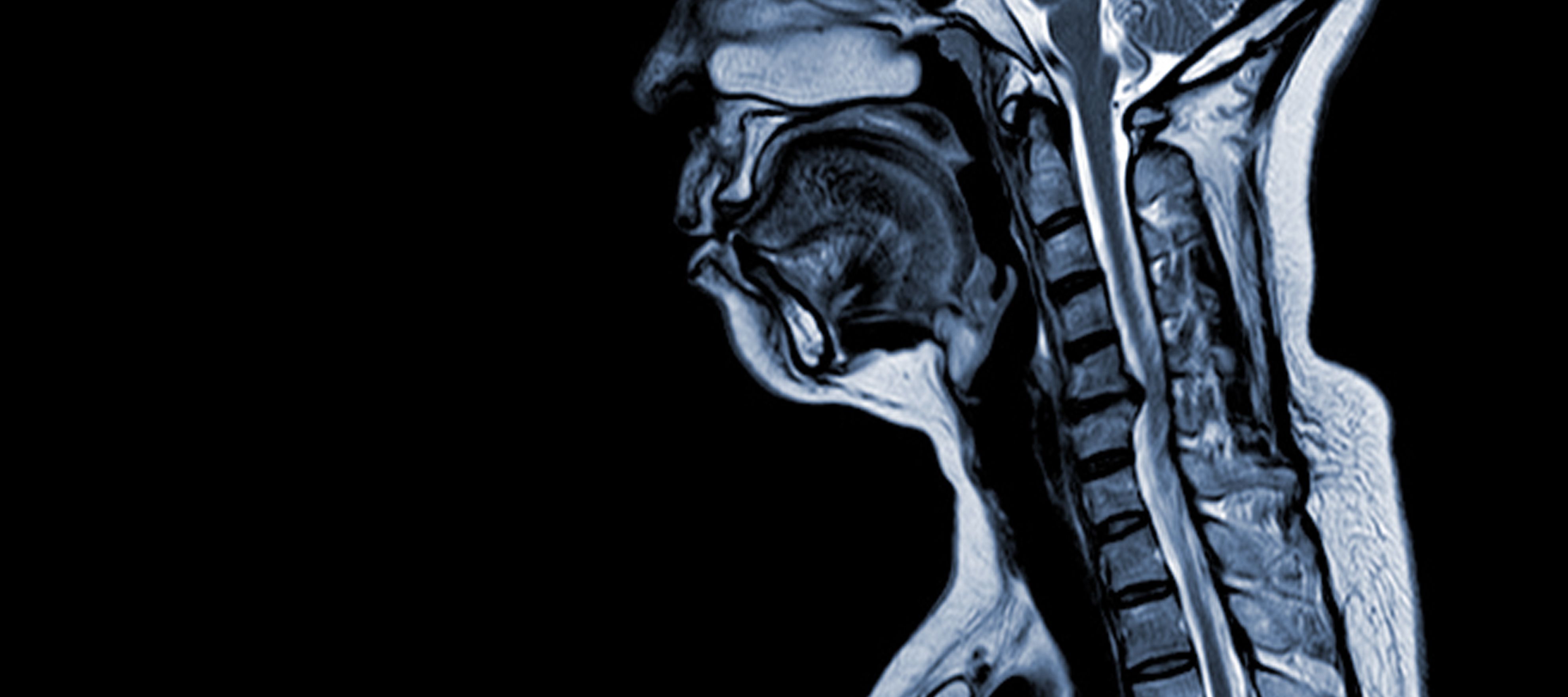 Cervical Spondylotic Myelopathy (CMS) | Diagnosis & Treatment