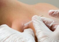 Dry needling