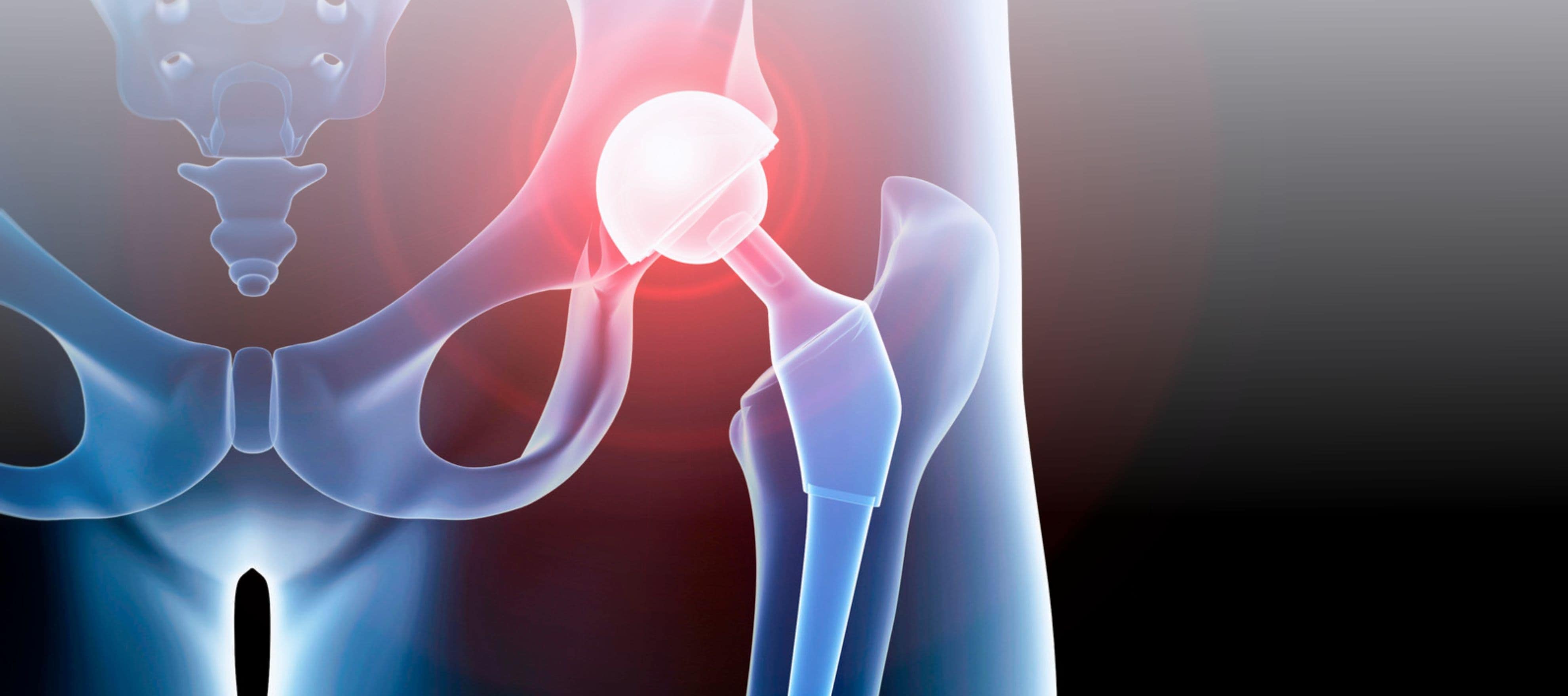 Successful Return to Running after Hip Replacment Masterclass