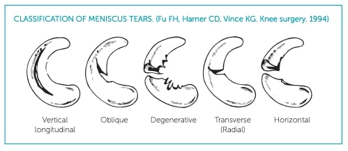 post-surgery meniscus rehabilitation