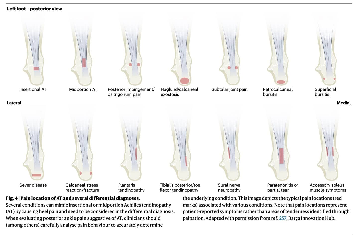 Neuropathic-Like Symptoms in Tendinopathy