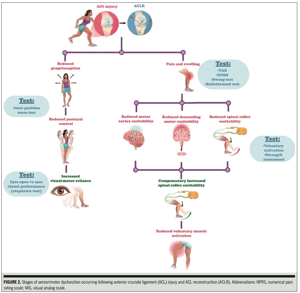 Sensorimotor Dysfunction Following ACL Injury