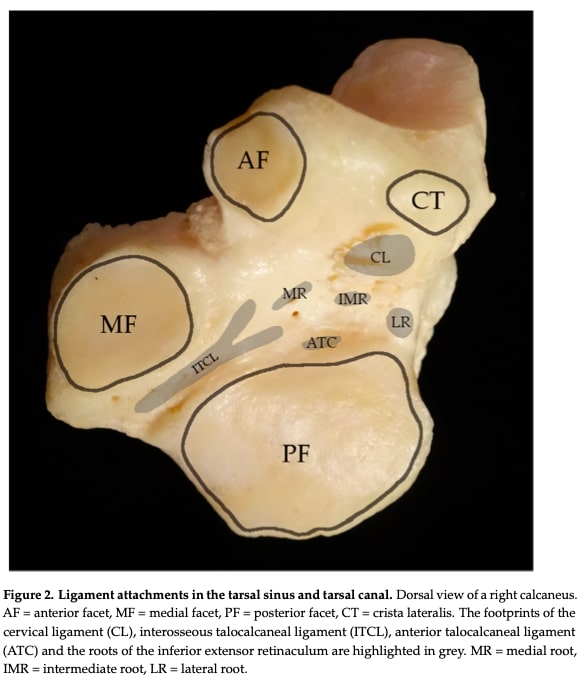 sinus tarsi syndrome treatment