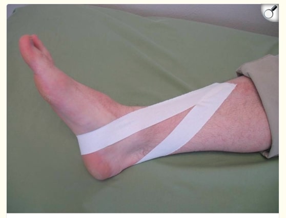 sinus tarsi syndrome treatment