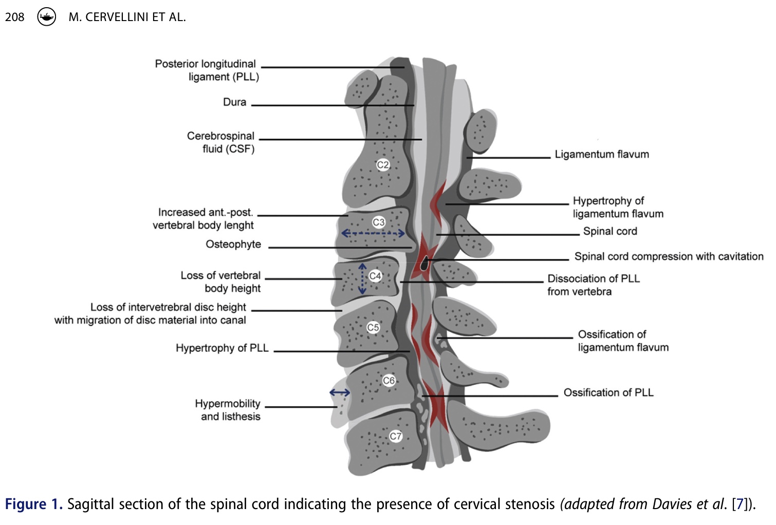 degenerative cervical myelopathy