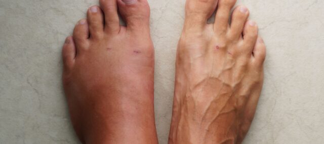 Rehabilitation interventions for crps (1)
