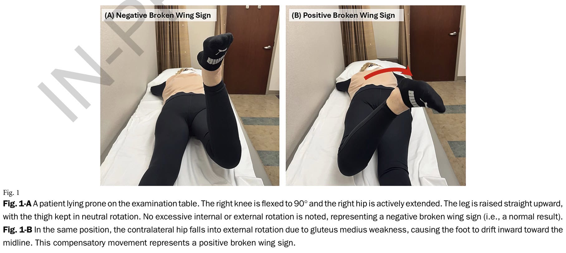 diagnóstico de los desgarros del tendón del glúteo medio