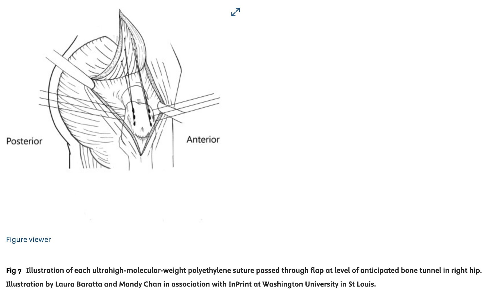 diagnóstico de los desgarros del tendón del glúteo medio