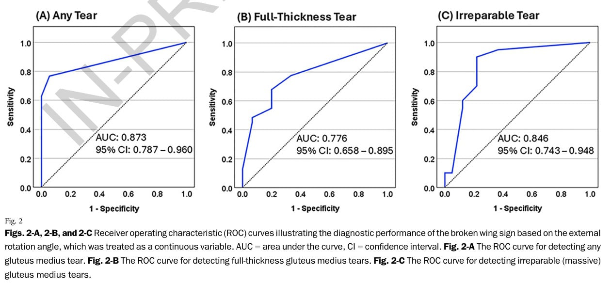 diagnóstico de los desgarros del tendón del glúteo medio