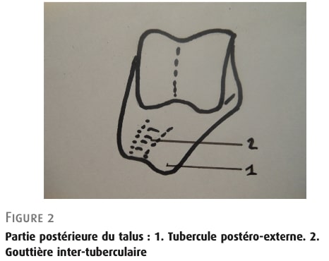 後足関節重心症候群