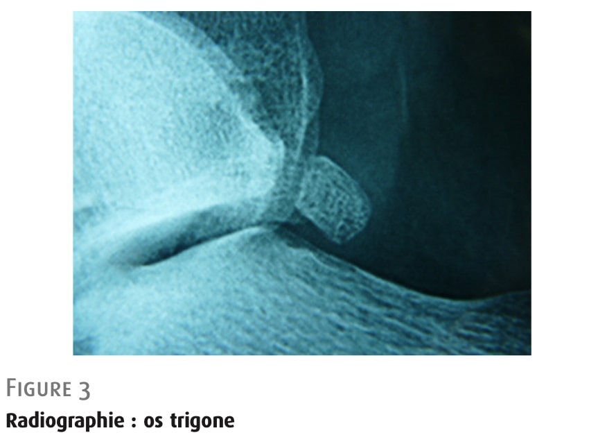 後足関節重心症候群