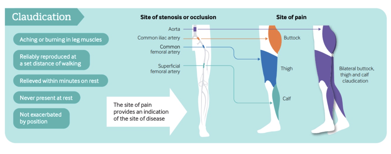 arteriální onemocnění dolních končetin