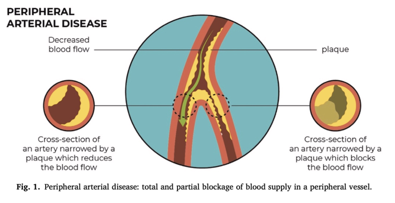 arteriální onemocnění dolních končetin