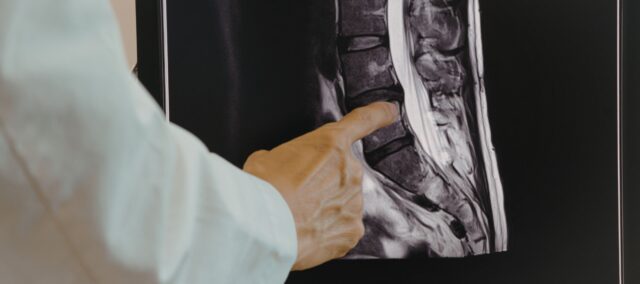 术前肌肉状况与腰椎间盘切除术结果