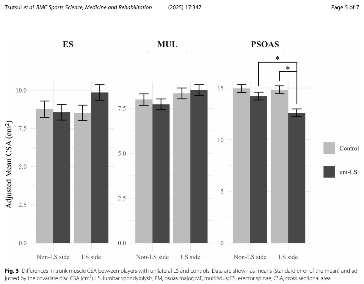 Lumbopelvic Control in Unilateral Lumbar Spondylolysis