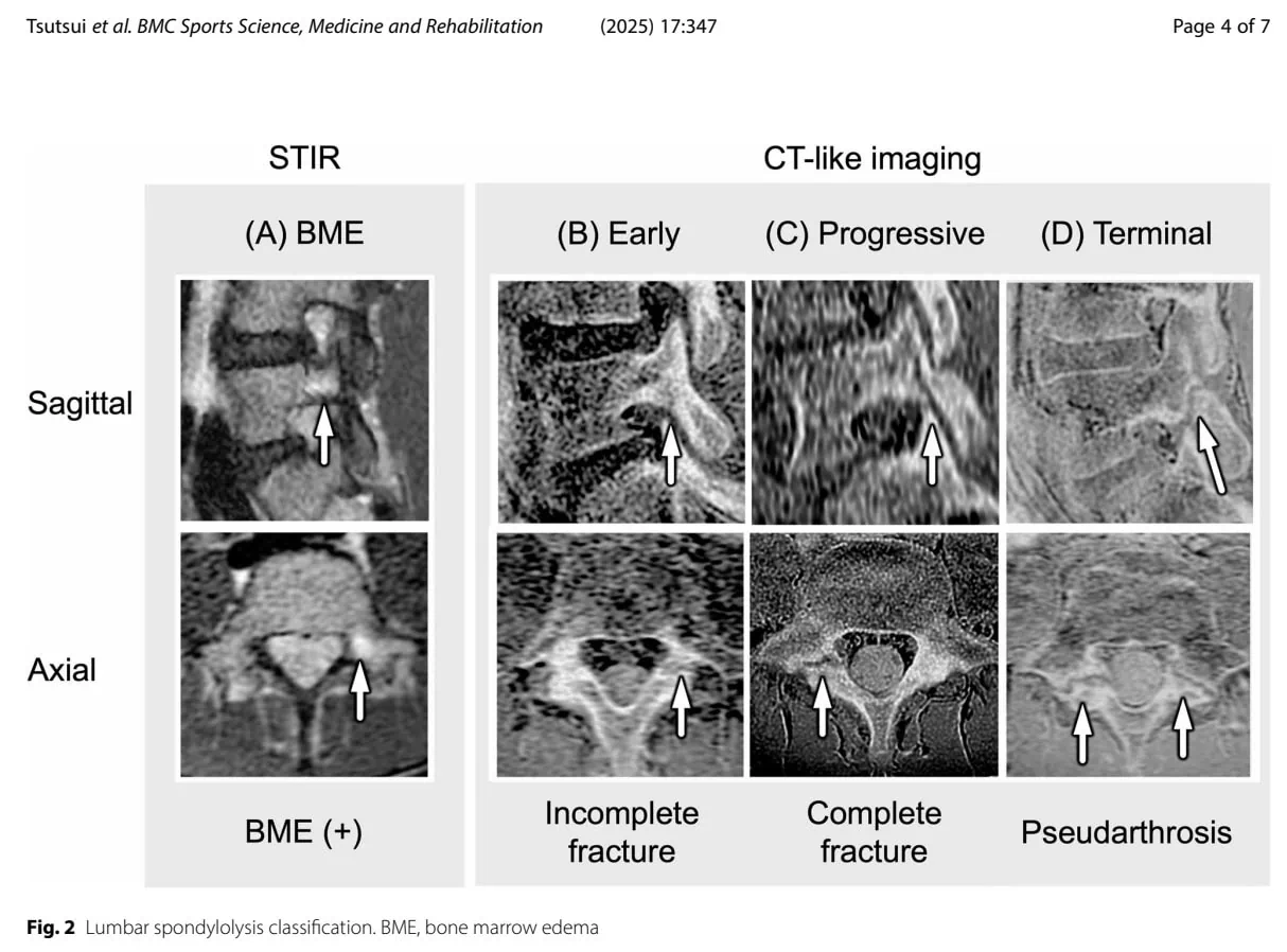 Lumbopelvic Control in Unilateral Lumbar Spondylolysis
